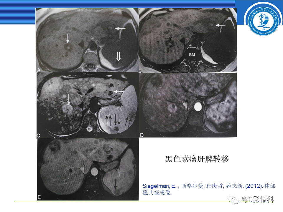 影像PPT - 【PPT】脾脏病变MRI表现-36