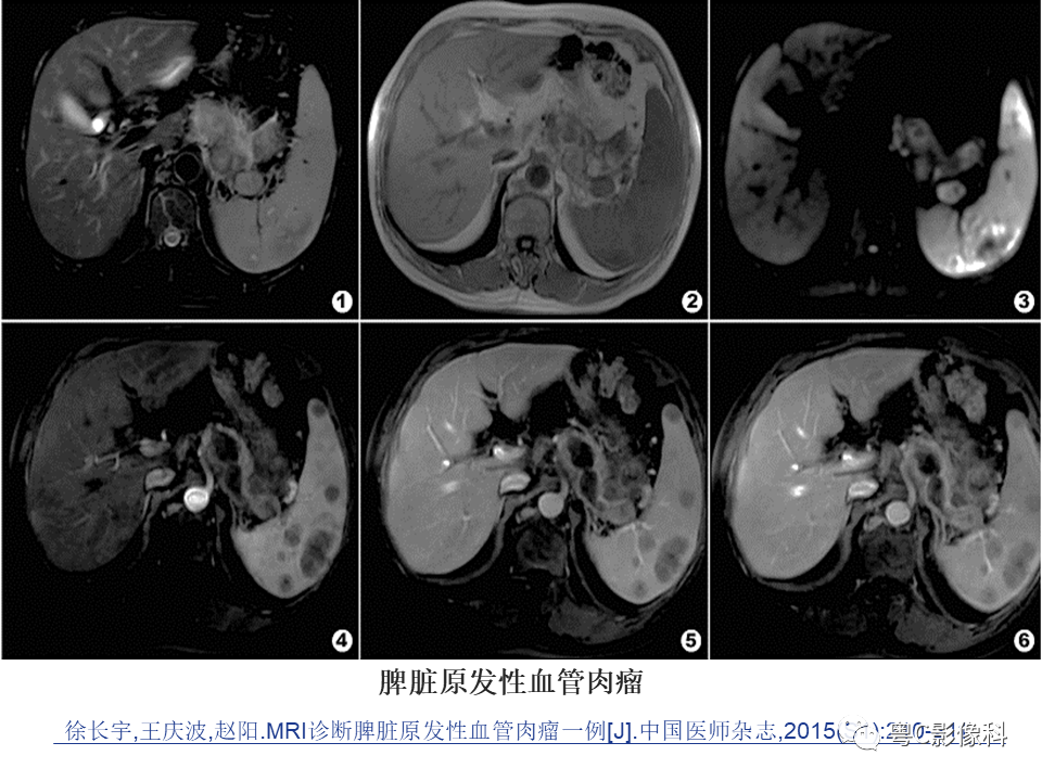 影像PPT - 【PPT】脾脏病变MRI表现-39