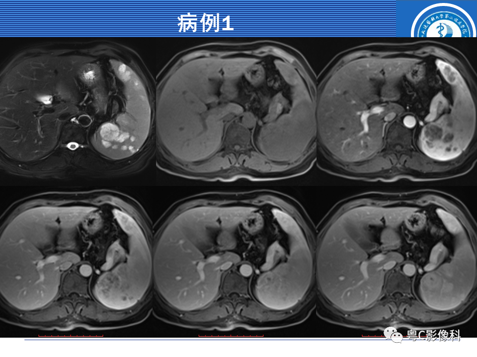 影像PPT - 【PPT】脾脏病变MRI表现-42