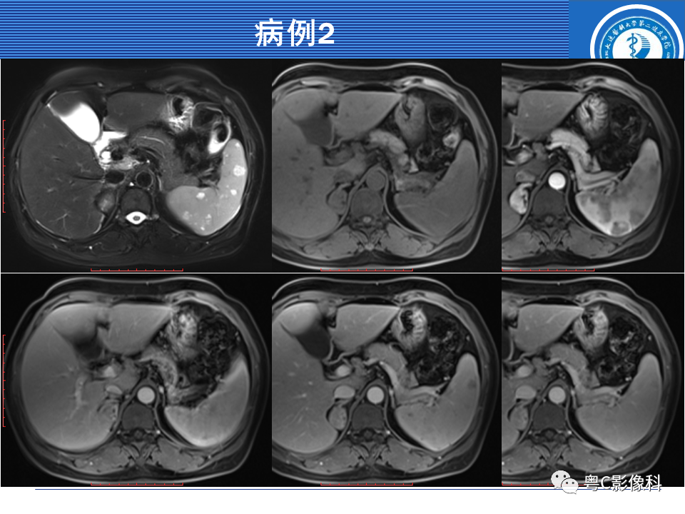 影像PPT - 【PPT】脾脏病变MRI表现-45