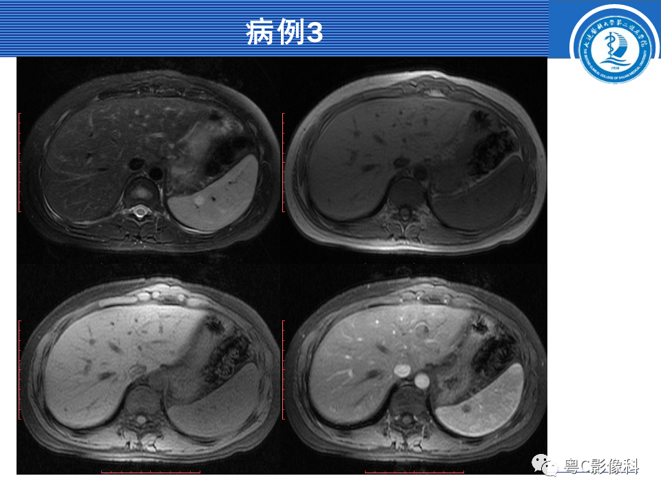 影像PPT - 【PPT】脾脏病变MRI表现-47