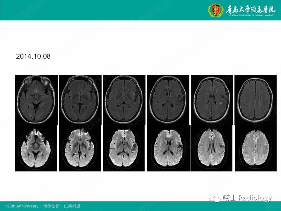 影像PPT - 【病例】中枢神经系统血管炎1例MR影像-8