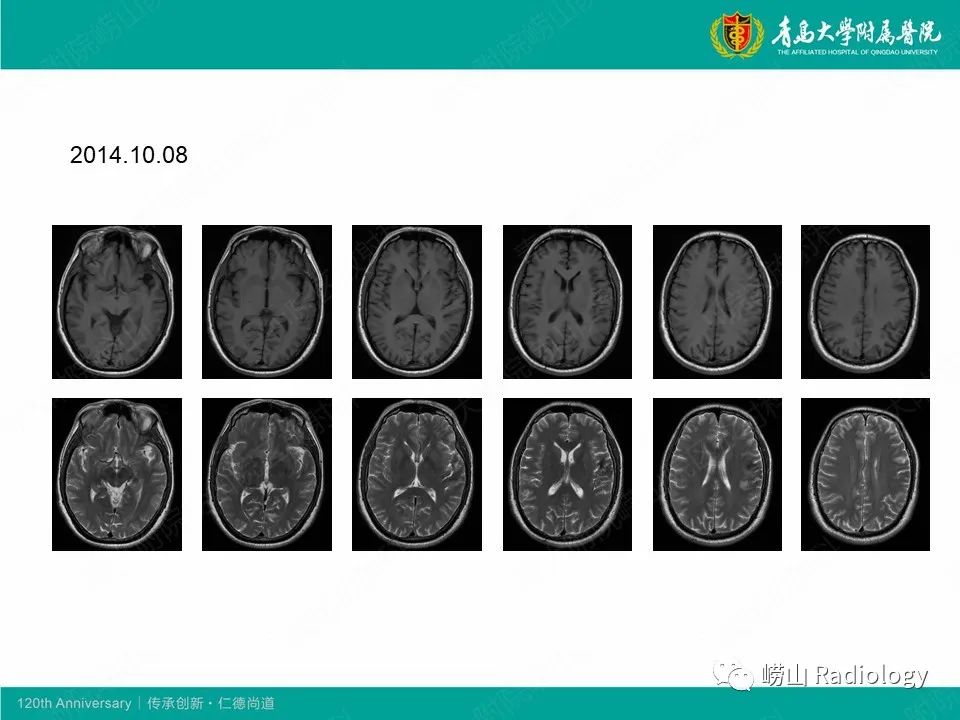 影像PPT - 【病例】中枢神经系统血管炎1例MR影像-7