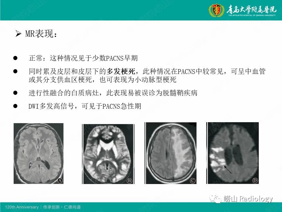 影像PPT - 【病例】中枢神经系统血管炎1例MR影像-26