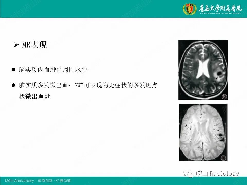 影像PPT - 【病例】中枢神经系统血管炎1例MR影像-27