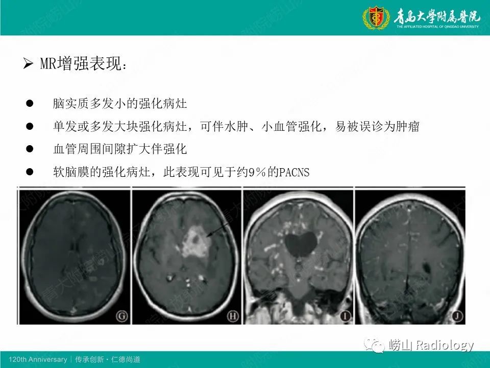 影像PPT - 【病例】中枢神经系统血管炎1例MR影像-28