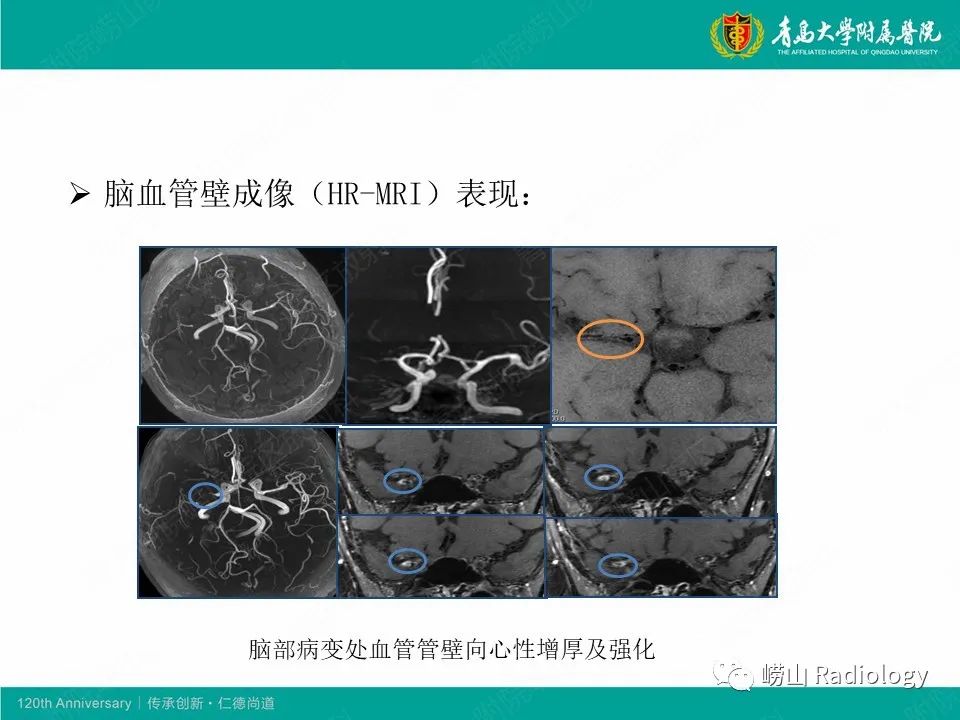 影像PPT - 【病例】中枢神经系统血管炎1例MR影像-30