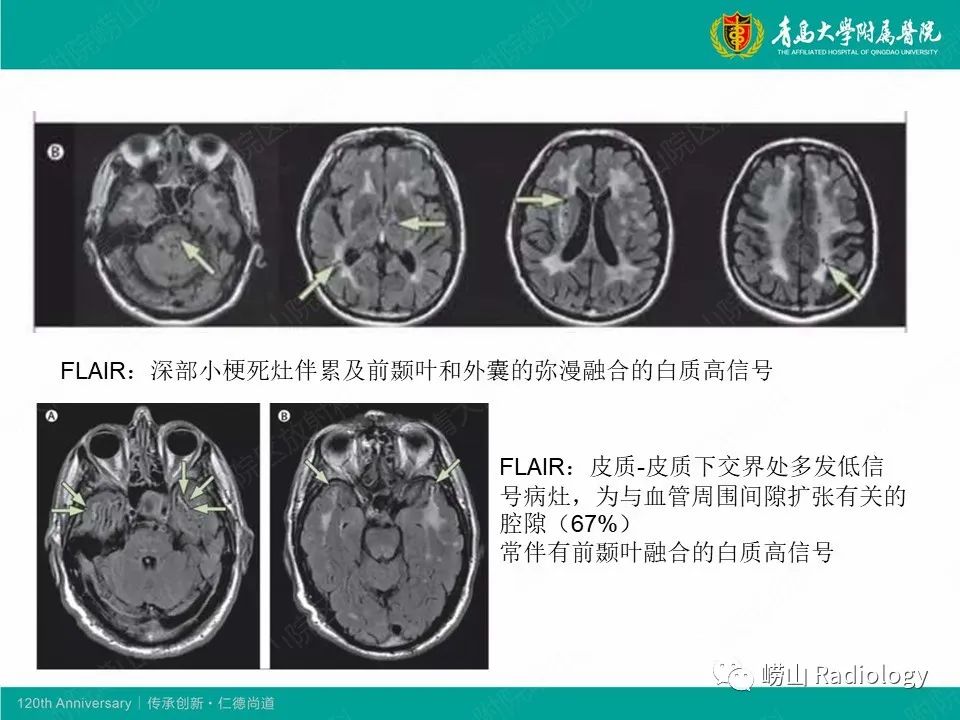 影像PPT - 【病例】中枢神经系统血管炎1例MR影像-33