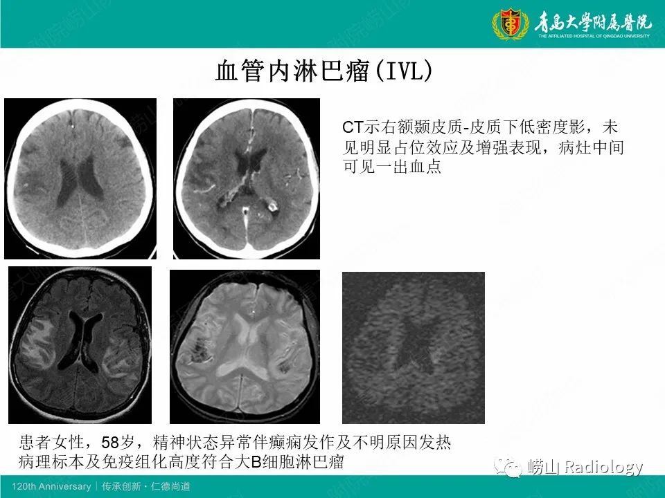 影像PPT - 【病例】中枢神经系统血管炎1例MR影像-35