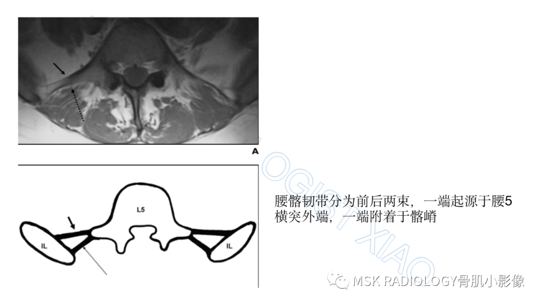 影像PPT - 【PPT】腰骶移行椎-5