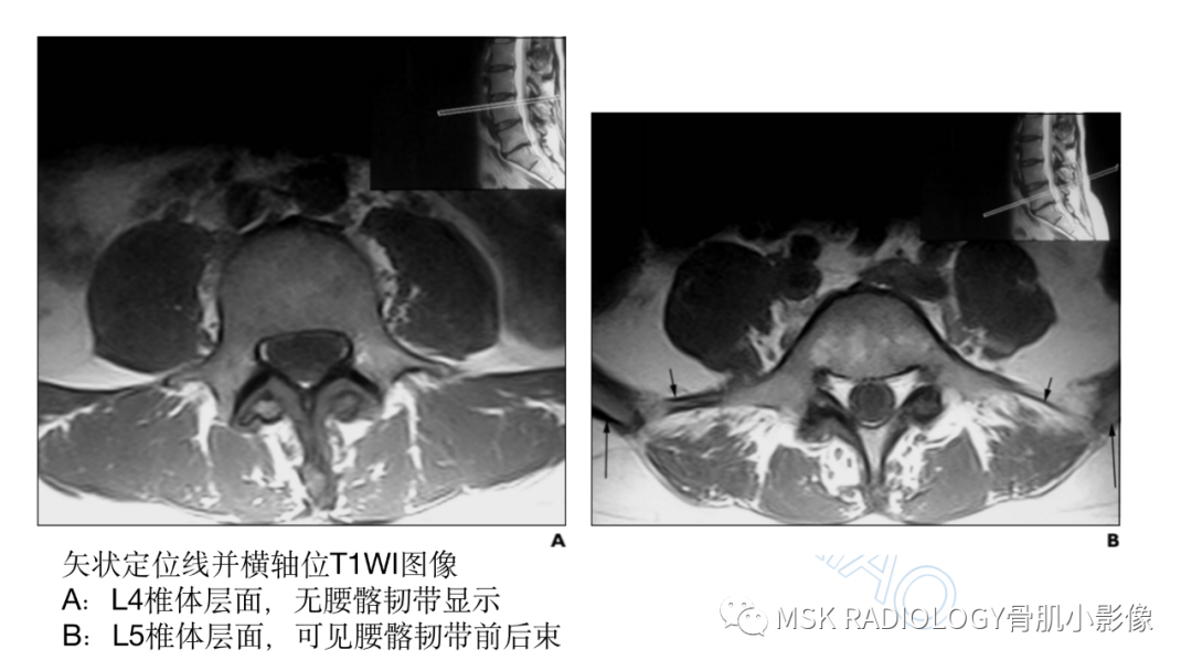 影像PPT - 【PPT】腰骶移行椎-6