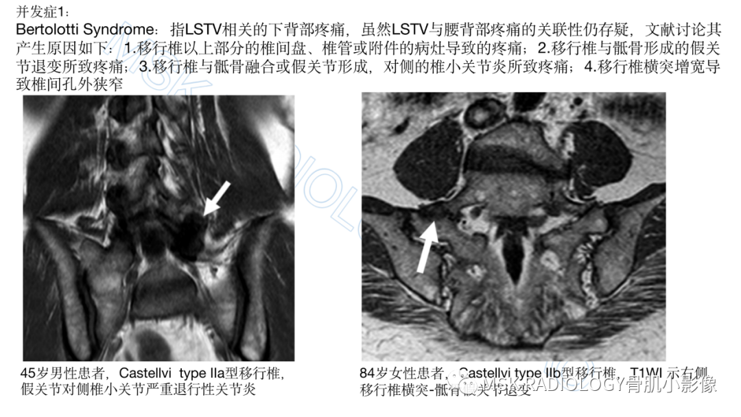 影像PPT - 【PPT】腰骶移行椎-4