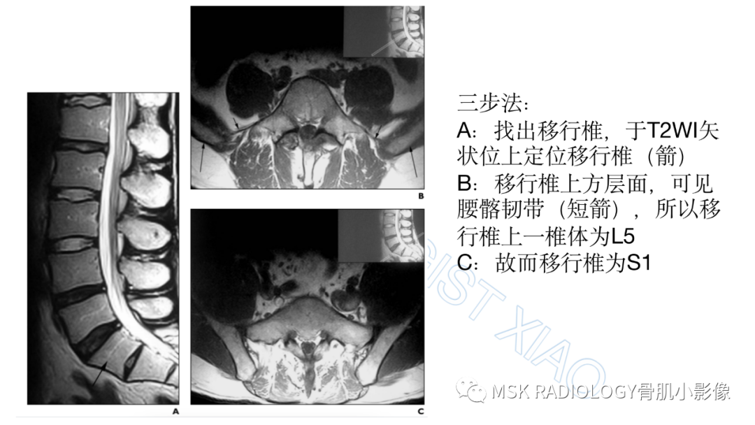 影像PPT - 【PPT】腰骶移行椎-7