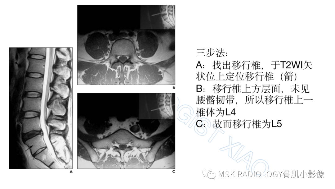 影像PPT - 【PPT】腰骶移行椎-8