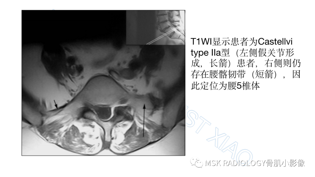 影像PPT - 【PPT】腰骶移行椎-9