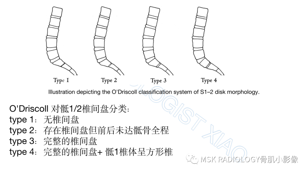 影像PPT - 【PPT】腰骶移行椎-3
