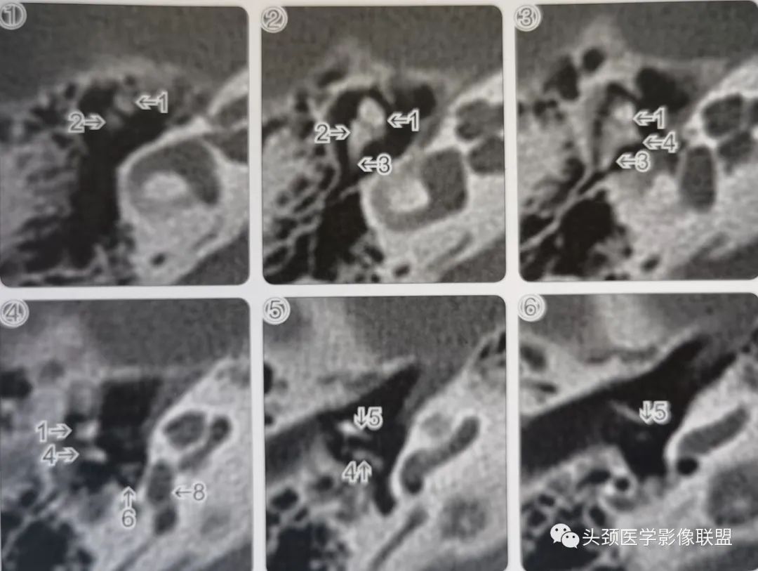 影像PPT - 听小骨影像解剖-2 影像PPT - 听小骨影像解剖-2