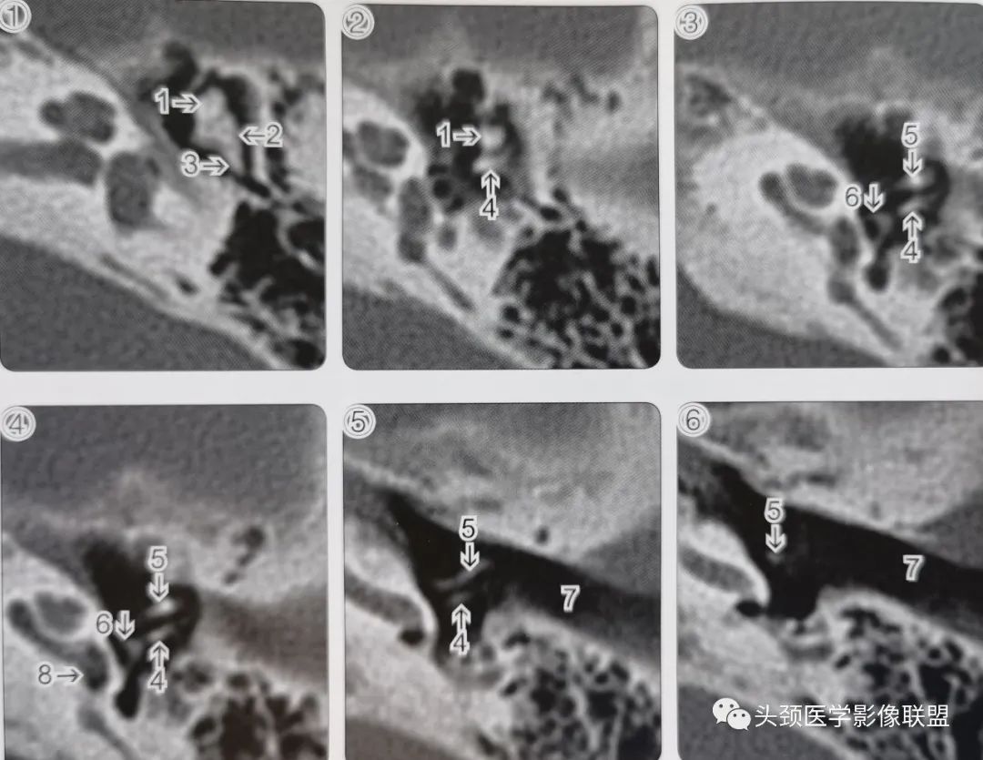 影像PPT - 听小骨影像解剖-4 影像PPT - 听小骨影像解剖-4