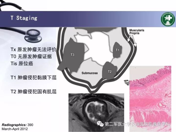 影像PPT - 【PPT】直肠癌MRI-10