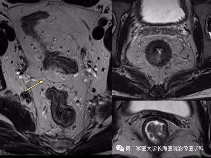 影像PPT - 【PPT】直肠癌MRI-9