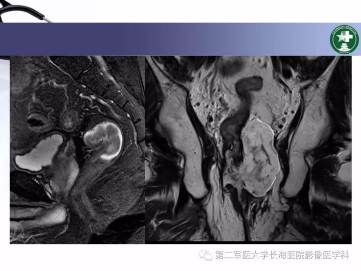 影像PPT - 【PPT】直肠癌MRI-6