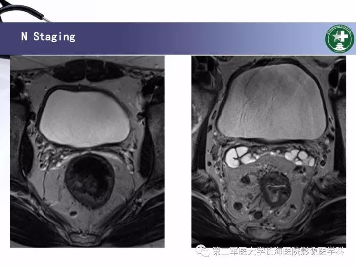 影像PPT - 【PPT】直肠癌MRI-21