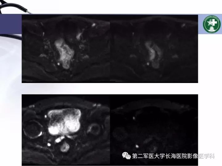 影像PPT - 【PPT】直肠癌MRI-23