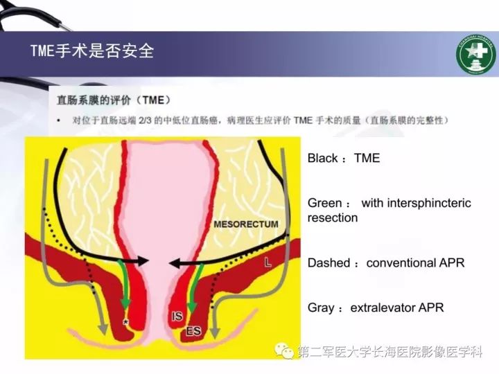 影像PPT - 【PPT】直肠癌MRI-25