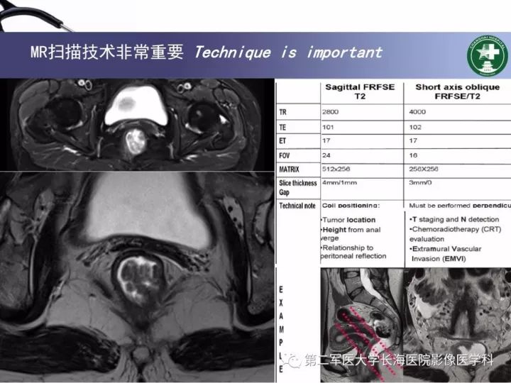影像PPT - 【PPT】直肠癌MRI-5