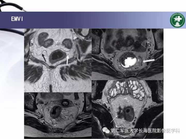 影像PPT - 【PPT】直肠癌MRI-29