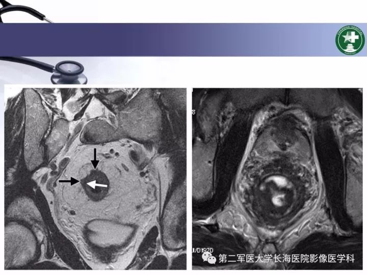 影像PPT - 【PPT】直肠癌MRI-14