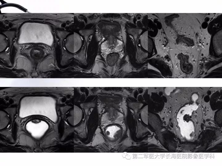 影像PPT - 【PPT】直肠癌MRI-32