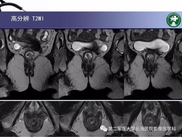 影像PPT - 【PPT】直肠癌MRI-17