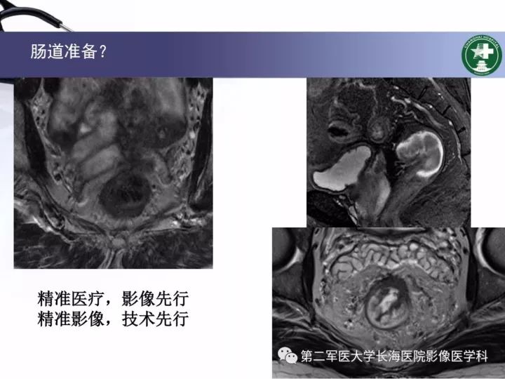 影像PPT - 【PPT】直肠癌MRI-33