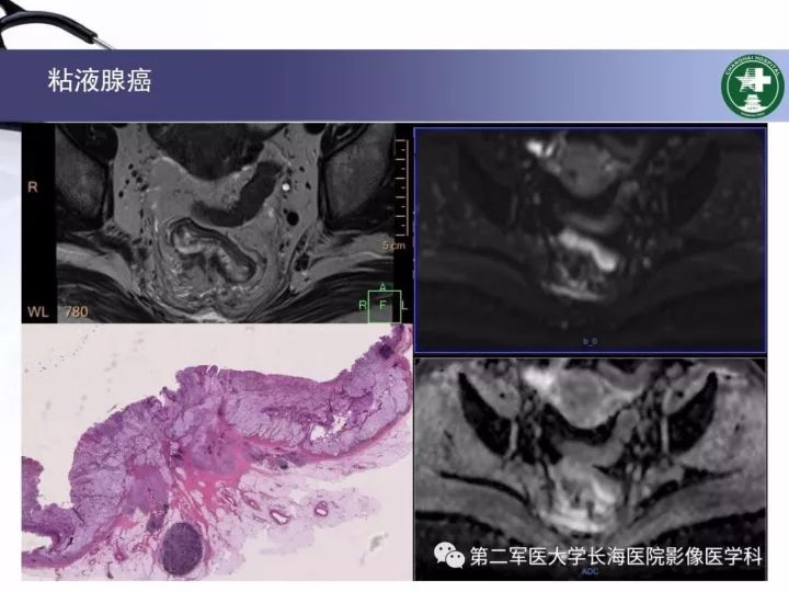 影像PPT - 【PPT】直肠癌MRI-35