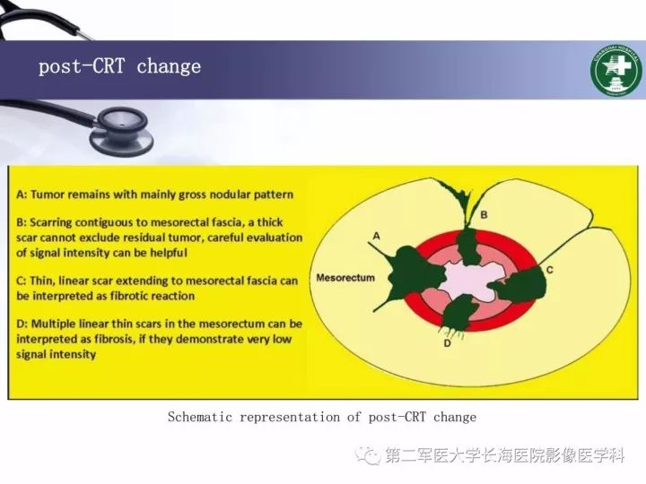 影像PPT - 【PPT】直肠癌MRI-36