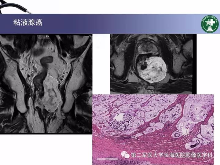 影像PPT - 【PPT】直肠癌MRI-34
