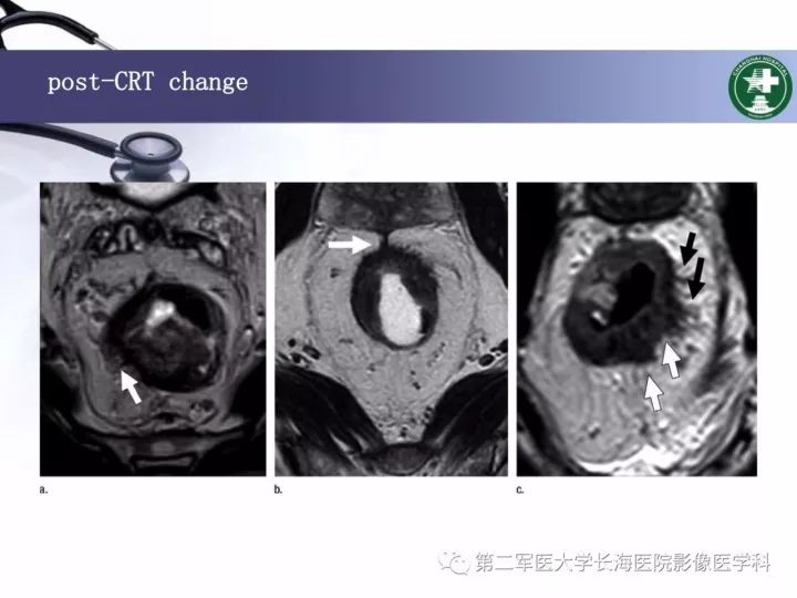 影像PPT - 【PPT】直肠癌MRI-37