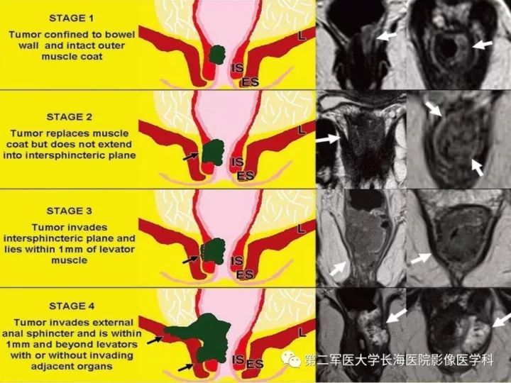 影像PPT - 【PPT】直肠癌MRI-18