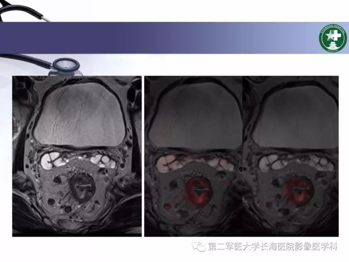 影像PPT - 【PPT】直肠癌MRI-44