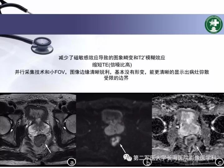 影像PPT - 【PPT】直肠癌MRI-43