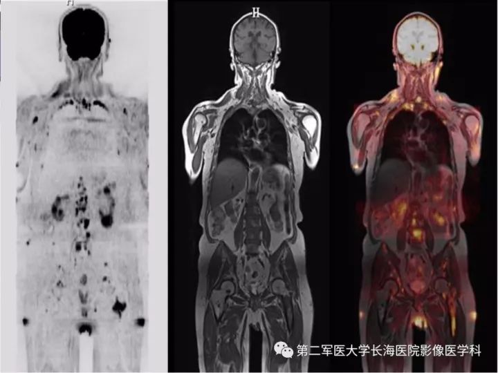 影像PPT - 【PPT】直肠癌MRI-51
