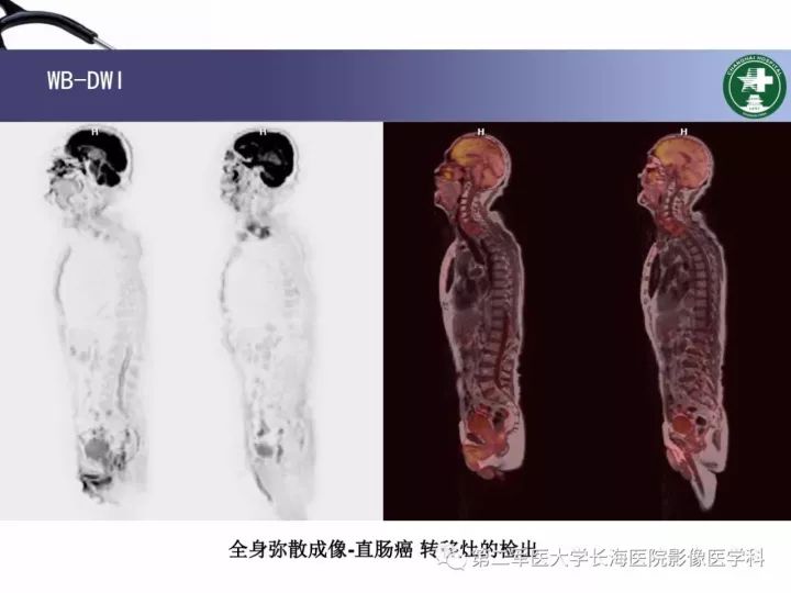影像PPT - 【PPT】直肠癌MRI-50
