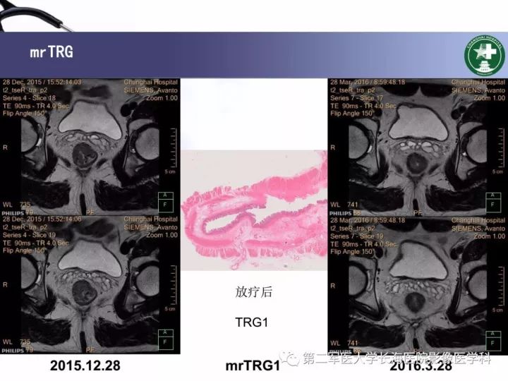影像PPT - 【PPT】直肠癌MRI-39