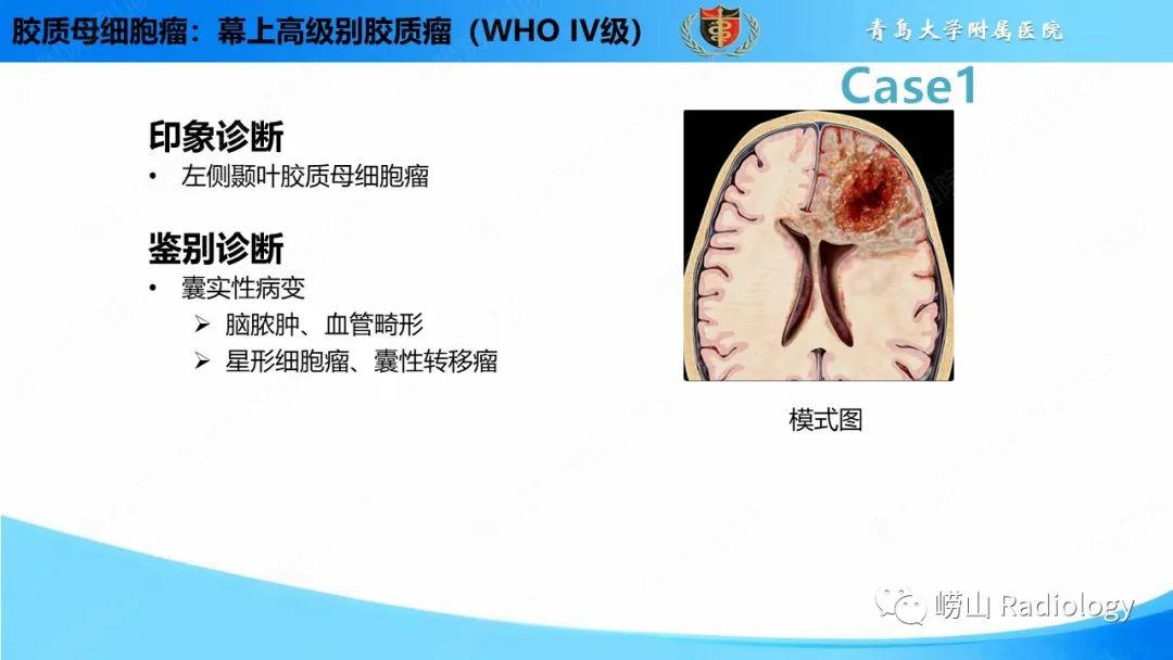 影像PPT - 【PPT】颅内肿瘤性病变-16