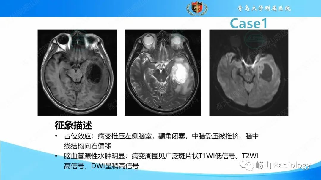 影像PPT - 【PPT】颅内肿瘤性病变-14