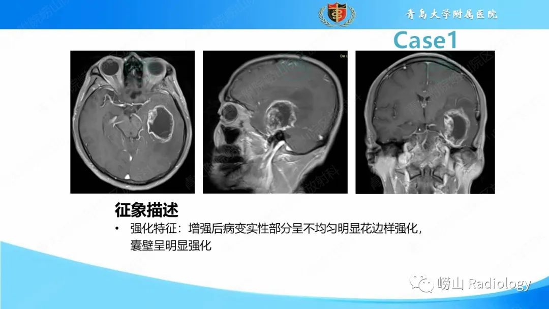 影像PPT - 【PPT】颅内肿瘤性病变-15