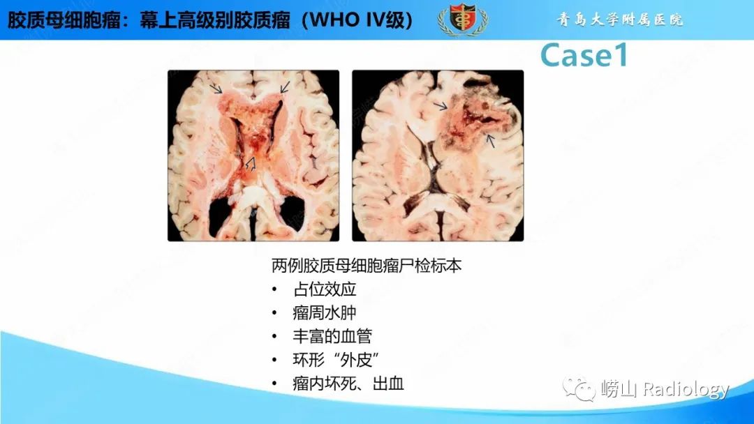 影像PPT - 【PPT】颅内肿瘤性病变-17