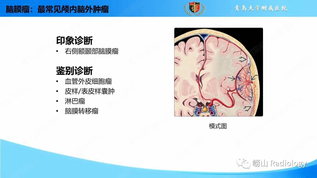 影像PPT - 【PPT】颅内肿瘤性病变-27