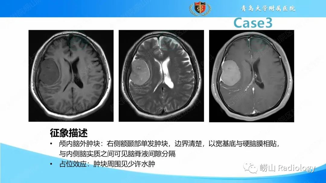 影像PPT - 【PPT】颅内肿瘤性病变-25